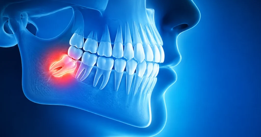 Wisdom Teeth